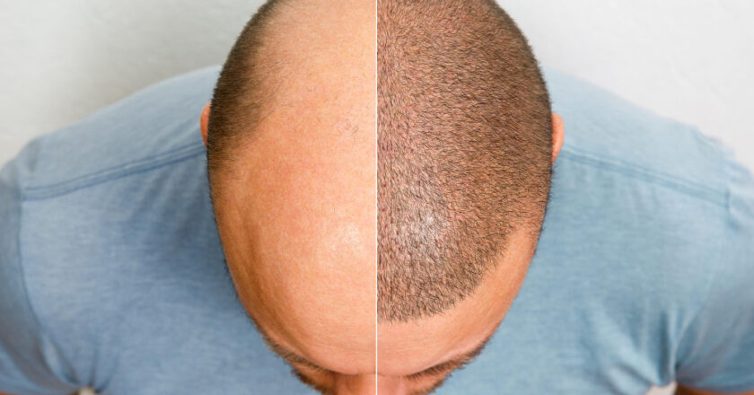 Przeszczep włosów – 5 faktów